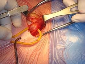 An operation for inguinal hernia is compulsory health mission the operated